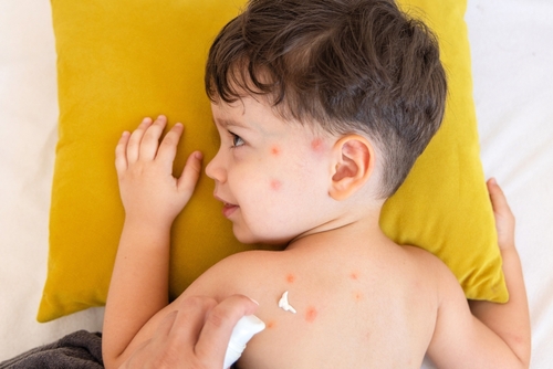 Best Bug Bite Creams for Kids